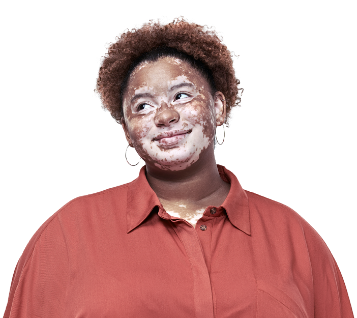 Woman with vitiligo